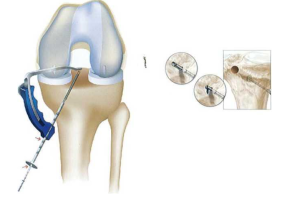 Khoan đường hầm chày tất cả bên trong dùng mũi khoan ngược Flip Culter