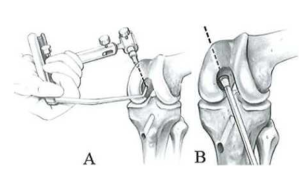  Khoan đường hầm xương đùi kỹ thuật từ ngoài vào (A) hoặc kỹ thuật từ trong ra (B)