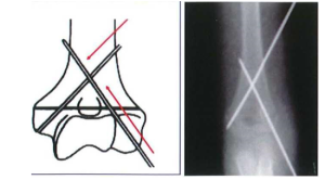 Kỹ thuật găm đinh chéo trong điểu trị gãy trên lồi cầu xương cánh tay