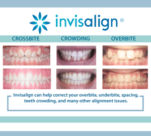 invisalign-alignment