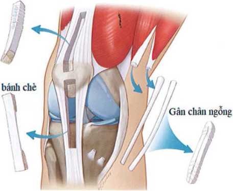 Minh họa các mảnh ghép tự thân thường dùng