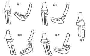 Phân loại gãy trên lồi cầu xương cánh tay trẻ em theo Lagrange and Rigault