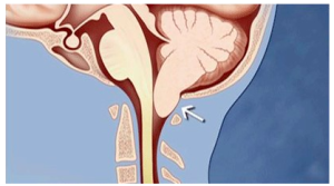 Hình ảnh thoát vị hạnh nhân tiểu não xuống dưới lỗ chẩm trong dị dạng Chiari loại I