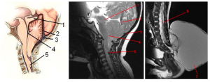 Hình vẽ minh họa và hình MRI của bệnh nhân bị dị dạng Chiari loại II cho thấy (1) biến dạng hình tam giác điển hình của củ não sinh tư, (2) xoang tĩnh mạch thẳng dựng đứng, (3) hội lưu tĩnh mạch có vị trí thấp, (4) cầu não và não thất tư kéo dài, (5) gai tủy, (6) tủy bám thấp, (7) thoát vị tủy – màng tủy thắt lưng.