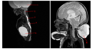 Hình MRI của hai bệnh nhân khác nhau bị dị dạng Chiari loại III cho thấy (1) não úng thủy, (2) sự di chuyển xuống dưới của hành tủy, não thất thứ tư và tiểu não, (3) rỗng tủy sống, (4) thoát vị tủy – màng tủy ngực – thắt lưng, (5) bàng quang thần kinh, (6) thoát vị tiểu não vùng chẩm.