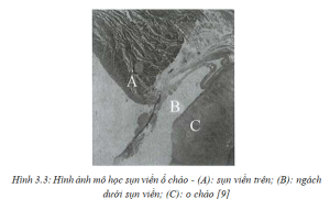 sụn viền trên