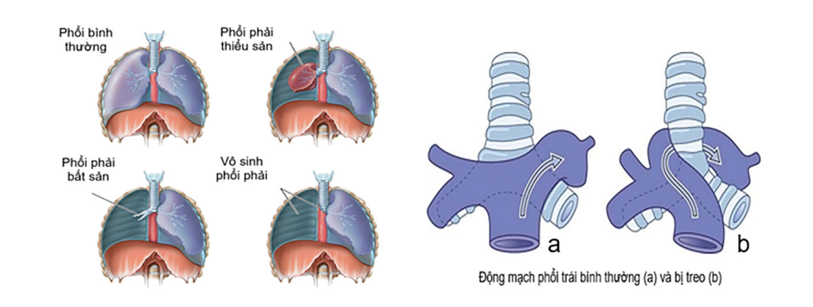 mo-hinh-cac-dang-di-tat-phat-trien-phoi (ben trai)- va-dong-mach-phoi-treo (hinh phai)