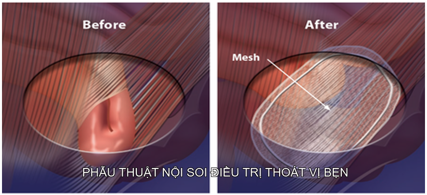 Tổng quan về phẫu thuật nội soi điều trị thoát vị bẹn