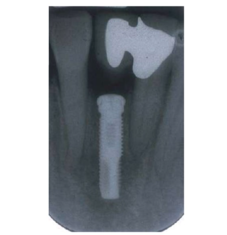 phau-thuat-implant-1