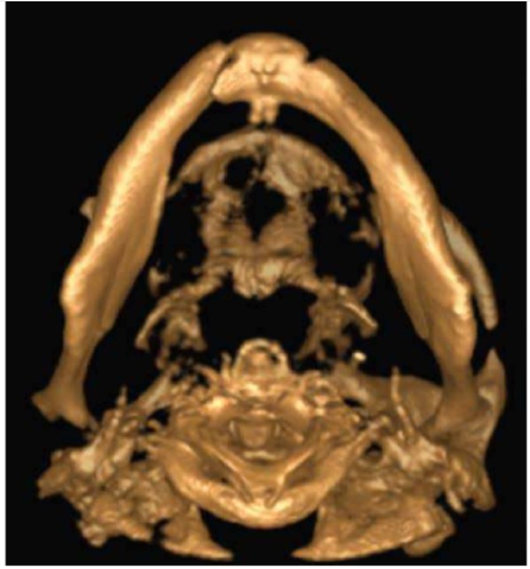 phau-thuat-implant-4