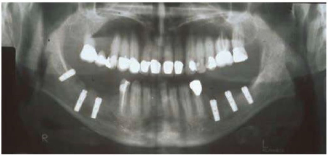 phau-thuat-implant-5