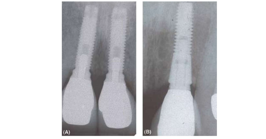 implant-2