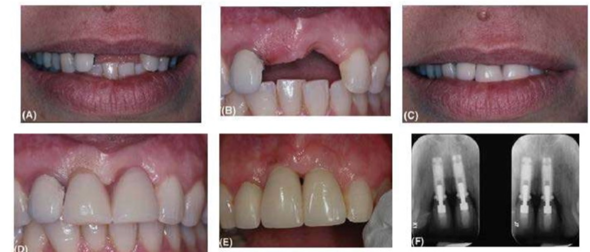 dieu-tri-implant