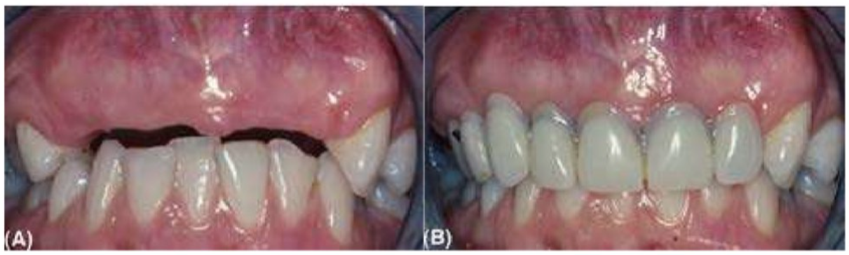 dieu-tri-implant-2