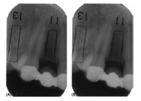 phau-thuat-implant-1