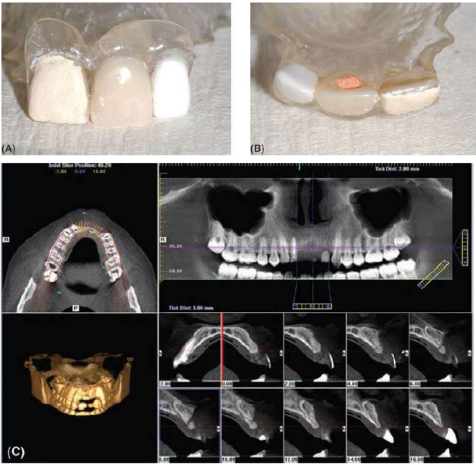 phau-thuat-implant-5