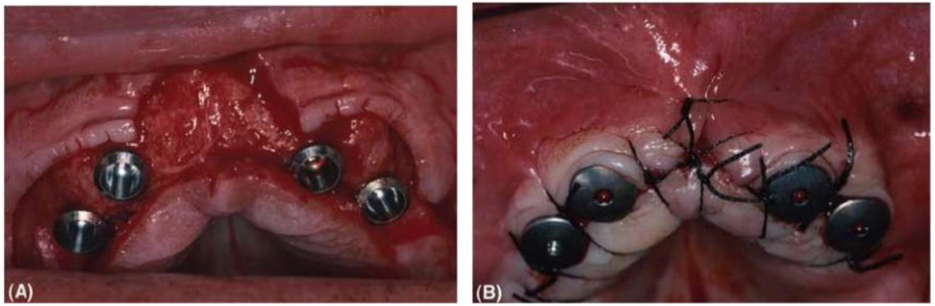 dat-abutment-1