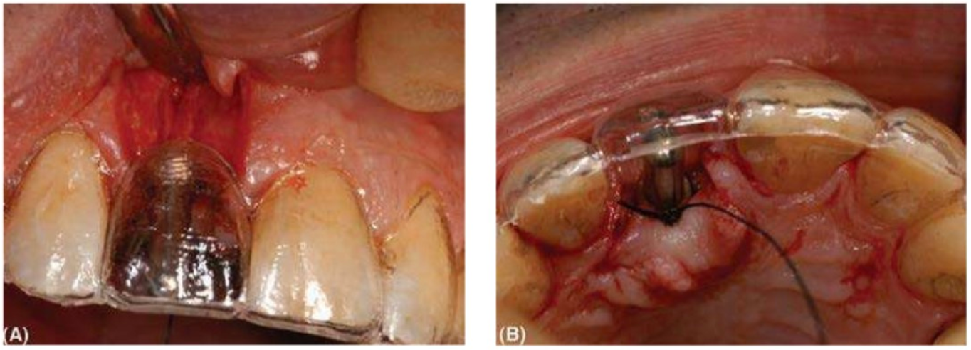 implant-vung-rang-cua