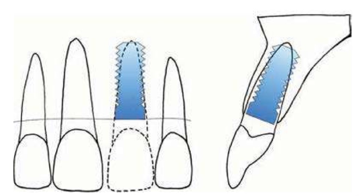 implant-vung-rang-cua-1