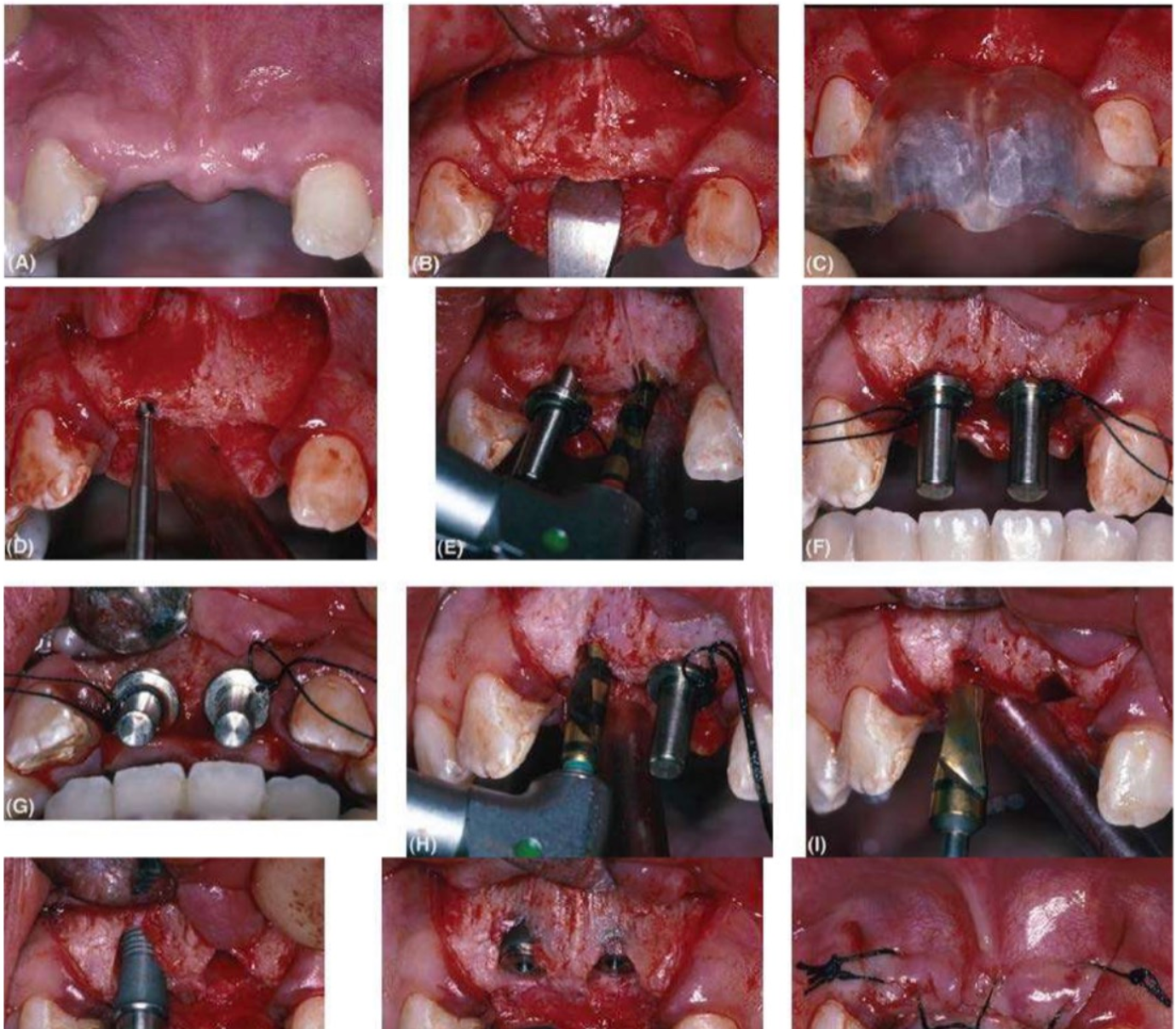 implant-vung-rang-cua-2