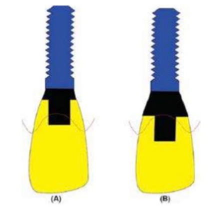 abutment-tieu-chuan-2