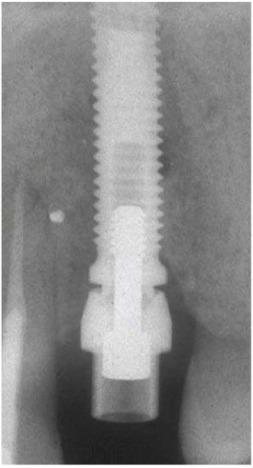 abutment-tieu-chuan-4