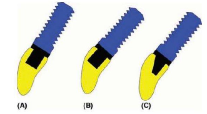 abutment-tuy-bien-2