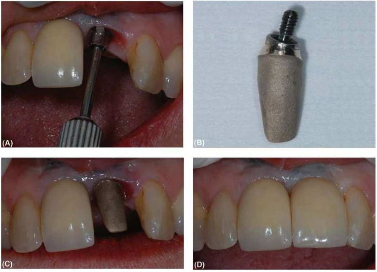 abutment-tuy-bien-3