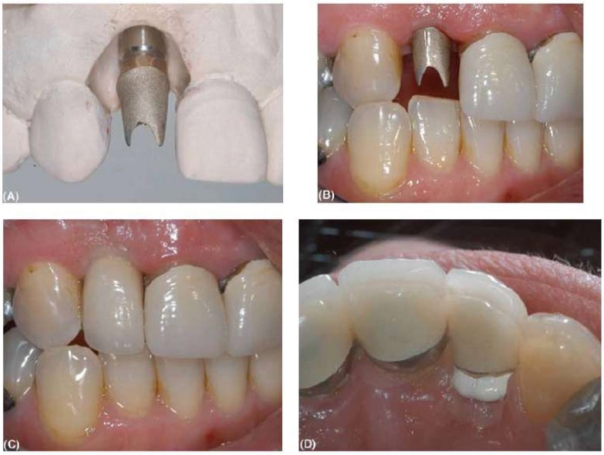 abutment-tuy-bien-5