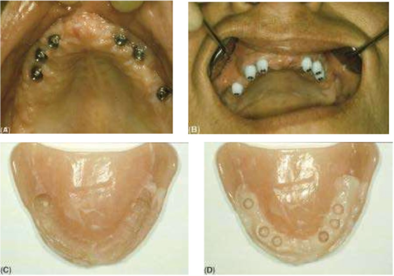 cac-loai-abutment-1