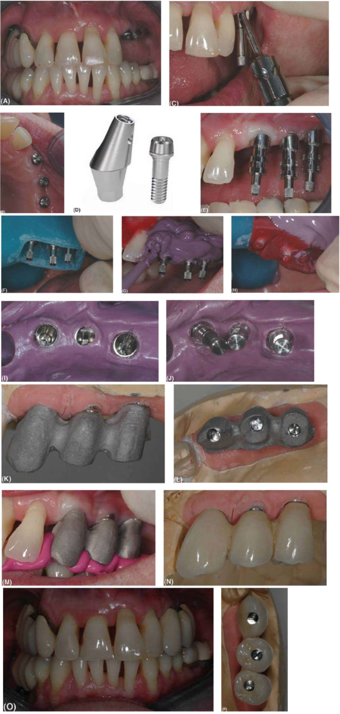 cac-loai-abutment-2