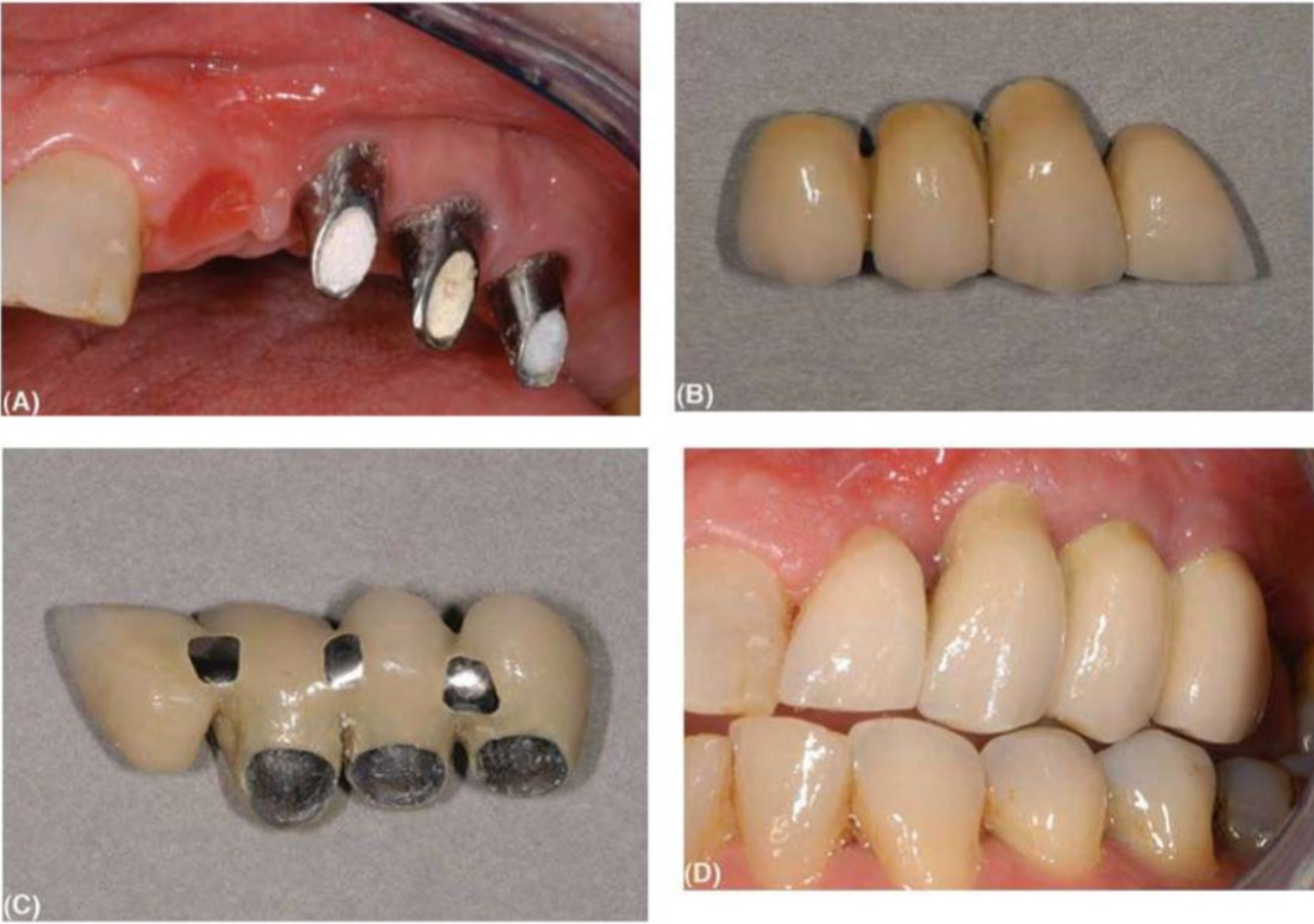 cac-loai-abutment-3