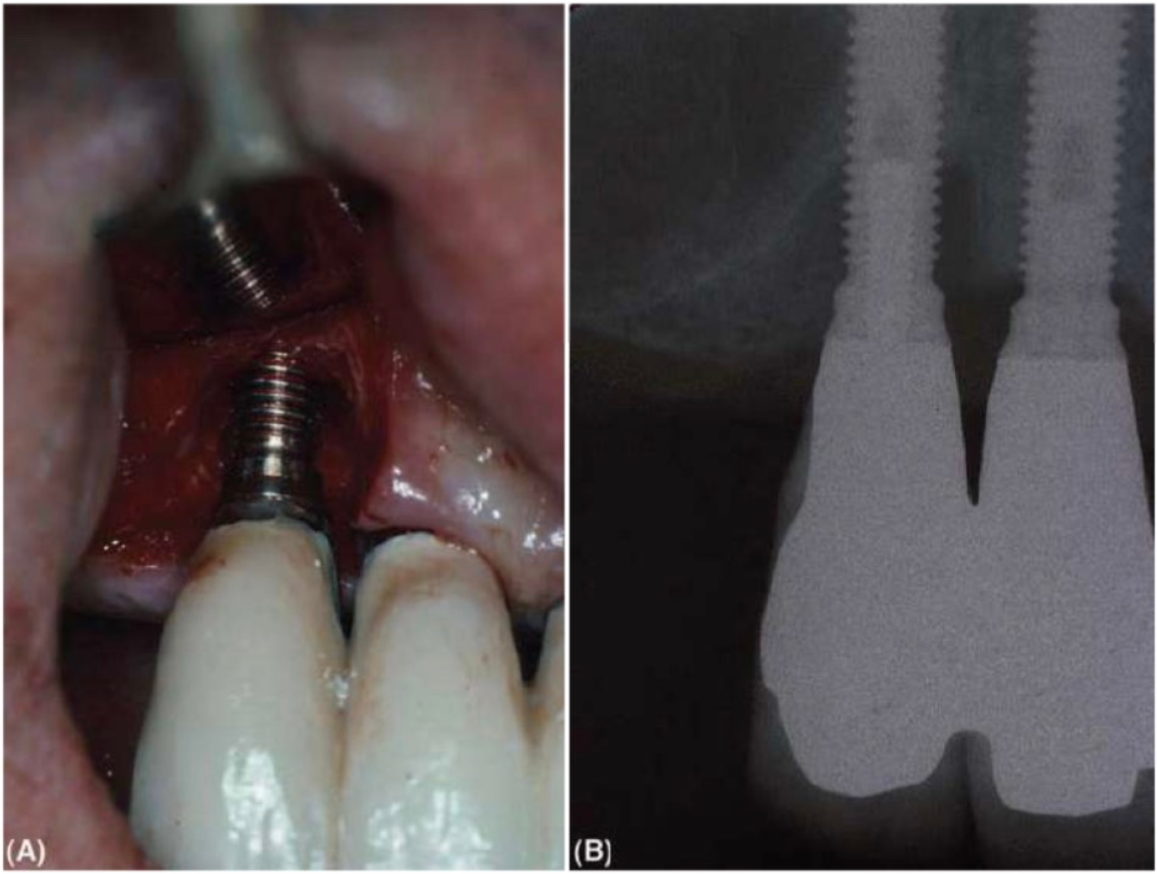 viem-quanh-implant-1