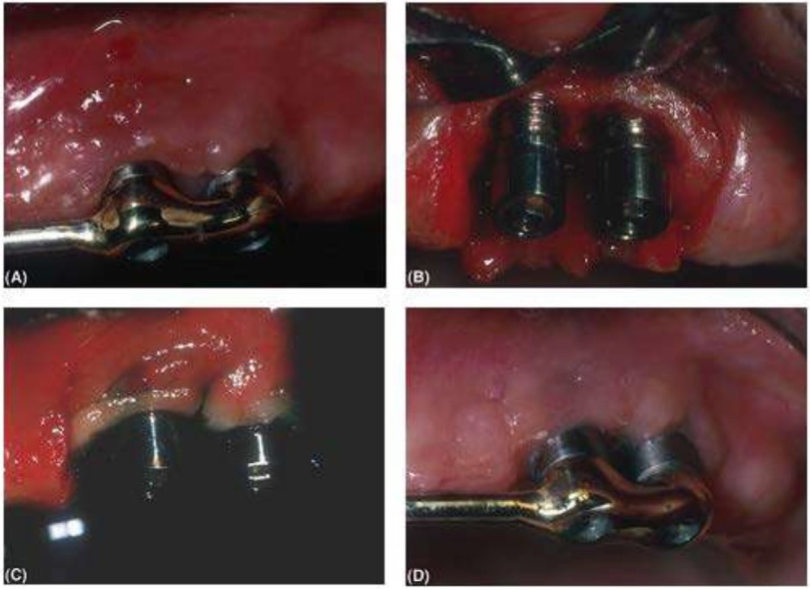 viem-quanh-implant-2