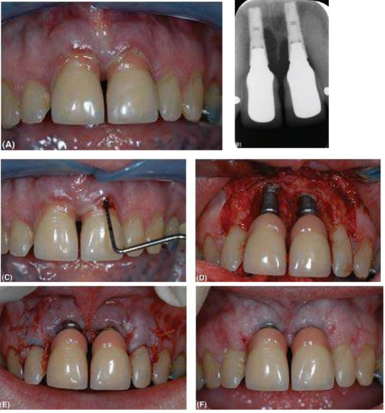 viem-quanh-implant-3