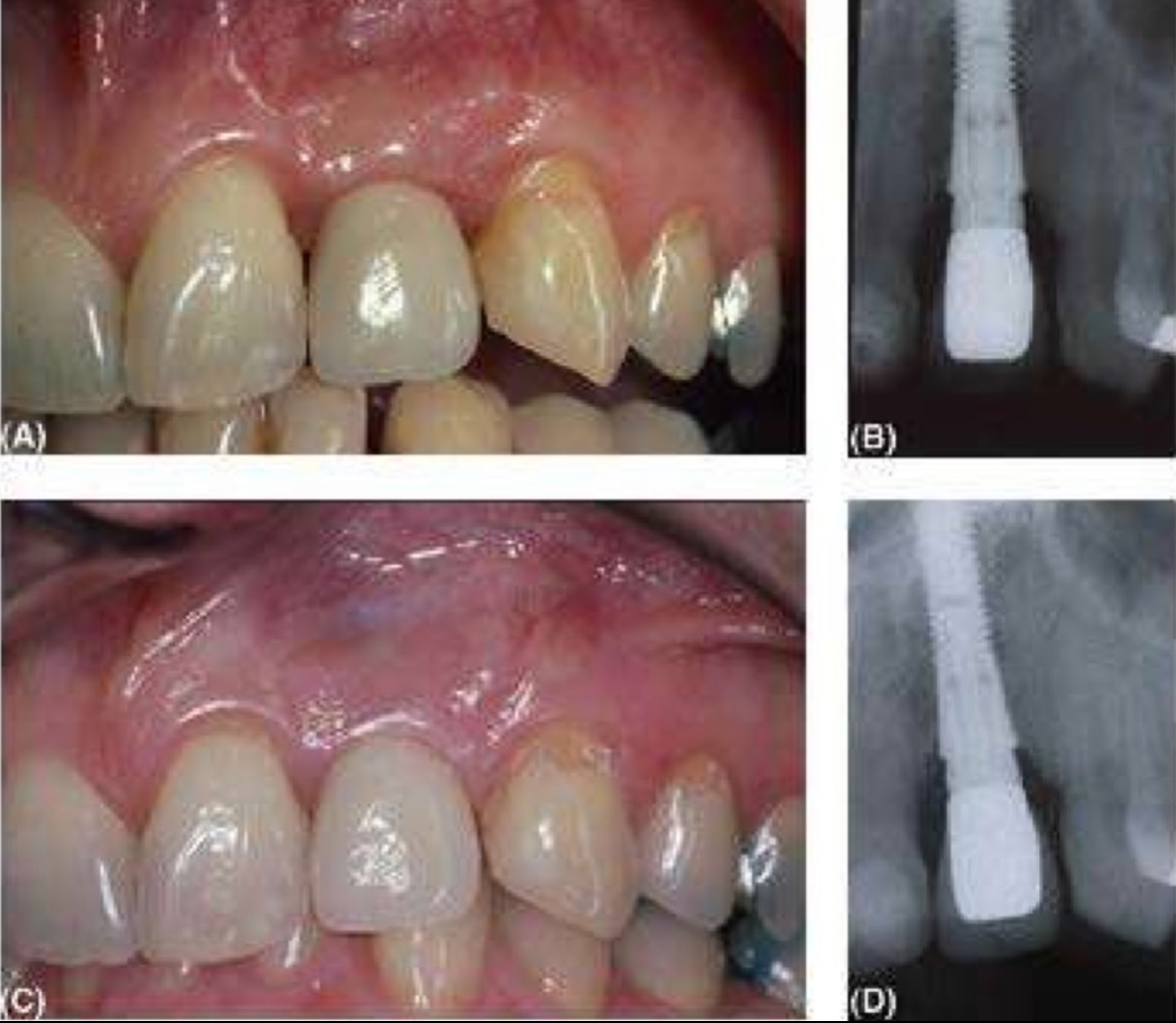 viem-quanh-implant-5