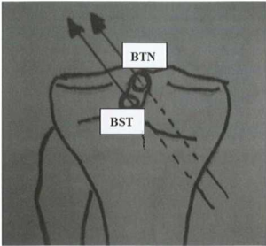 Vị trí đường hầm chày của BTN và BST