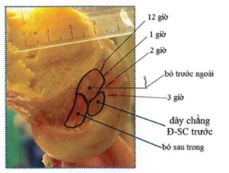 Vị trí giải phẫu diện bám đùi của DCCS và các bó cấu thành