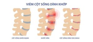 Viem-cot-song-dinh-khop