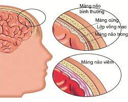 Minh-hoa-viem-mang-nao