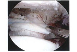 ảnh minh họa: Nông kéo khi cắt tách gân trên gai và dưới gai Nguồn: AANA Advanced Arthroscopy (2010), The Shoulder