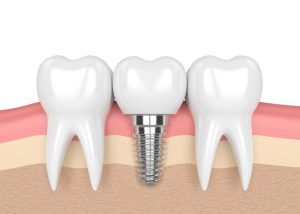 rang-implant-1