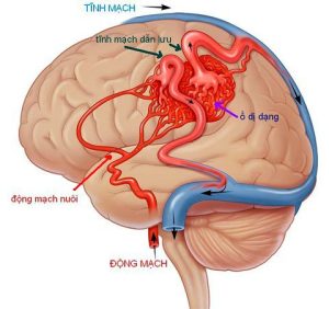 đôt quỵ xuất huyết não