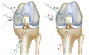 cố định mảnh ghép dây chằng chéo sau ở đường hầm chày bằng nút treo và cố định mảnh ghép ở đường hầm đùi của BTN bằng vít chẹn và BST bằng nút treo