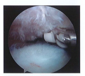 ảnh minh họa: Đốt điện và mài mịn mặt dưới mỏm cùng vai Nguồn: AANA Advanced Arthroscopy (2010), The Shoulder