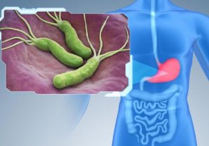 Viêm dạ dày mạn tính có thể dovi khuẩn Helicobacter pylori gây ra