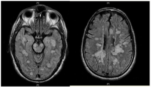 hình ảnh MRI viêm não tủy lan tỏa cấp tính