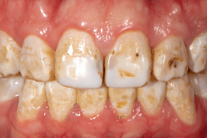 rang-nhiem-fluorosis