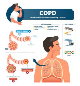 Phục hồi chức năng hô hấp cho bệnh nhân COPD giúp cải thiện triệu chứng của bệnh