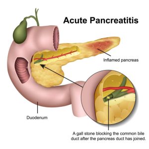 Thang điểm BISAP (Bedside Index for Severity in Acute Pancreatitis) là một công cụ được sử dụng để đánh giá mức độ nghiêm trọng của viêm tụy cấp.